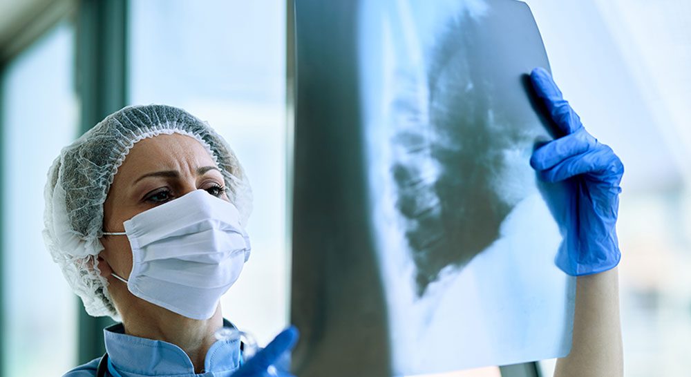 Articles lung cancer